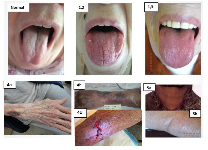 Figure 11: It is not unusual for a clinician unfamiliar with the cutaneous signs of Scurvy deficiency to dismiss the clinical signs as actinic keratosis or bruising. This figure demonstrates advanced Scurvy with the 3 cardinal signs: Dermal atrophy, purpura, and a skin tear.