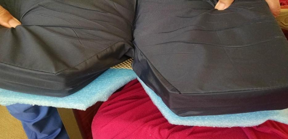 Figure 8: This patient has wounds at the fibular head and lateral malleolus. He insists on a frog leg position. Memory foam was custom carved to create a trough for the lower extremity with depressions at the wound locations.