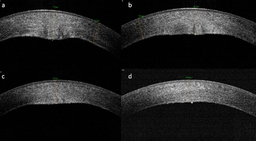 Figure 2: Case-2: ASOCT images. (a)Before starting treatment; (b) 02 weeks after starting treatment; (c) 01 month after starting treatment; (d) Two months after starting treatment