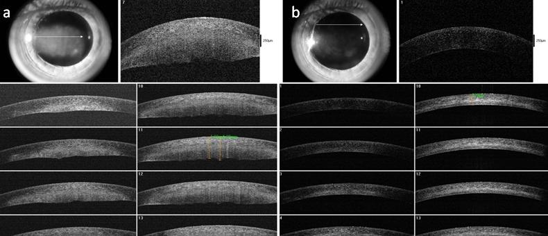 Figure 3: Case-3 ASOCT image. (a) Before starting treatment; (b) 03 wks after starting treatment