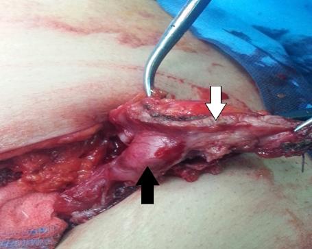 Figure 2: An Excised ellipse of the transverses abdominis muscle and the rectus abdominis Muscle (white arrow) with the edematous, adherent left fallopian tube (black arrow).