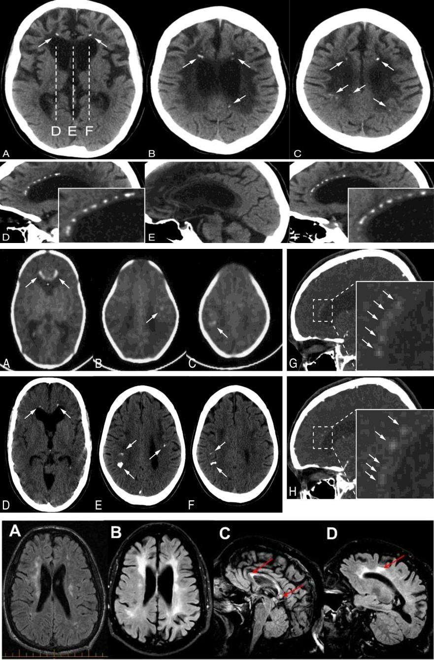 Figure 5: Radiological Image of Blood vessel Disorders in the Brain of People with Adult-onset Leukoencephalopathy with Axonal Spheroids and Pigmented Glia Syndrome.
