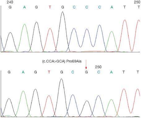 Figure 9: Schematic of the nucleotide sequence of the mutated gene of EPM2A in patients.