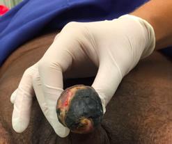 Figure 3: Ulcerated lesion with necrotic edges in the glans