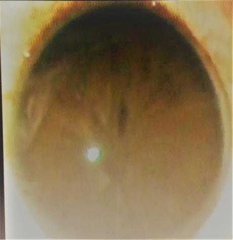 Figure 2: Showing a slit like pupil following atropinization.