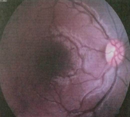Figure 4: Showing normal fundus after pupilloplasty.