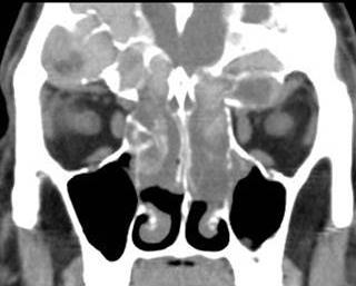 Figure 5: Transaxial CT image through the orbits show right ethmoid air cells and sphenoid sinus disease with hyperdense contents with expansion. This results in right lamina papyracea lateral displacement compressing the right orbital contents and proptosis.