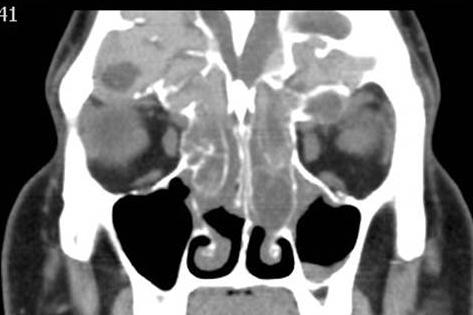 Figure 6: Coronal (A) and sagittal (B) CT of the paranasal sinuses show extensive pansinusitis with expansion of the right ethmoid air cells and dehiscence of the cribriform plate and the walls of the sphenoid sinuses resulting in intracranial extension limited by the dura. It extends through both lamina papyracea into the orbit. The right maxillary and ethmoid disease expansion obliterates nasal cavity.