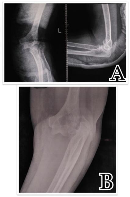 Figure 1: (A & B) Anteroposterior and lateral view of the elbow showing Fracture-Dislocation of the lateral condyle of humerus.