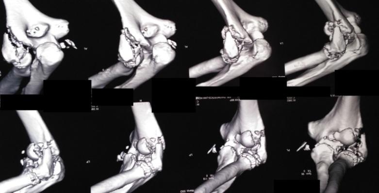 Figure 2: CT Scan demonstrating gross comminution of the lateral condyle.