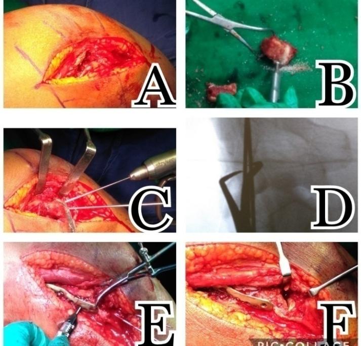 Figure 3: Intraoperative images showing, (A) Severe comminution of the condylar fracture fragment, (B) Procured en-bloc Iliac bone graft refashioning to fill the defect, (C) Refashioned graft was used to fill the defect and temporarily fixed in position using K-wires, (D) C-arm images showing K-wire holding the graft in position (E & F) Graft was secured using Locking plate. Severe comminution of the lateral humeral condyle fragment with intact lateral epicondylar fragment with attached radial collateral ligament was seen (Figure 3A). Due to the severe comminution, reconstruction of the distal humerus was not possible. Iliac bone graft of size 1.5x 1.5 cm was procured and was refashioned to a size to fill into the defect (Figure 3B). Temporary fixation was performed with two K-wires (Figures 3C & D) and definitive fixation was done using 3.5 mm distal humerus variable angle locking plate (Figures 3E & 3F). Closed reduction and fixation with two K-wires was done for distal end radius fracture. Intra-operatively, a good range of motion of 5-110 was achieved. Elbow was stable throughout the range of motion arc and to varus- valgus stress. Clinico-radiological follow-up was done at 2 weeks, 6 weeks, 3 months and 6 monthly thereafter. Post- operatively, elbow joint was immobilized in arm sling pouch for 3 weeks. Range of motion exercises was started at 3 weeks. Clinical outcome was assessed using Mayo Elbow Performance Index (MEPI) [13]. Radiographs at every follow-up were assessed for healing, heterotopic ossification, and implant associated complications. Radiological healing was achieved at 12 weeks with no signs of heterotopic ossification (Figure 4). At last follow-up of 1 year, the arc of flexion-extension was 1080 with flexion of 1380 and extension deficit of - 20°, supination of 85° and pronation of 76° (Figure 5). MEPI score at the last follow-up of 1 year was 93.
