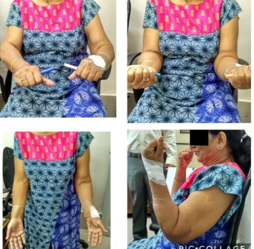 Figure 5: Clinical images showing good functional movement.