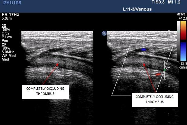 Figure 1: Venous Doppler showed complete thrombotic occlusion.