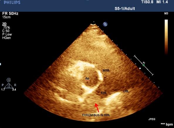 Figure 2: Obstructing proximal right pulmonary artery.