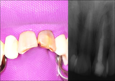 Figure 1: A: Pre op image. B: Pre op radiograph. An endodontic therapy was performed in tooth number 8 and an endodontic revision in tooth9. After local anesthesia and positioning of rubber dam, both teeth were treated and tooth 9 was dismantled. The guttapercha was removed with Gates Glidden bur#2 and #3 (Dentsply Maillefer, Ballaigues, Switzerland) and limes Hedstroem #30 (Dentsply Maillefer, Ballaigues, Switzerland). Channels were shaped and remodeled with Pro Taper Universal rotary system and channels 8 and 9 were filled. (Figure 2) shows the complete sequence. A B C
