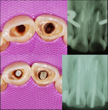 Figure 3: A and B: Posts spaces. C and D: Checking post adjustment and length. Selected posts were checked according to depth and were adapted using composite (Z100, 3M ESPE, St. Paul MN, USA) by taking the root canal impression with manual pressure and polymerization (Figure 4).