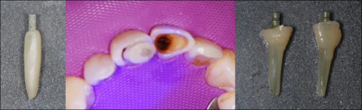 Figure 4: A and B: Adapting composite. C: After polimerization. Then, the concrete poles cementing was made with dual resin (Paracore, Coltene Whaledent) together with the radiographic check. Both pieces were rationally prepared with moderate chamfer termination. Soft tissues were prepared for impression using wire separation and the final impression was taken with silicone addition in one step (Zhermack Elite HD). Pure porcelain restorations (e.max, Ivoclar Vivadent) using resin cement were installed. Figure 5 shows the complete sequence Figure 6 shows an enlarged view of the final picture.
