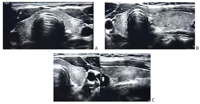 Figure 1: The thyroid gland in longitudinal and transverse planes. A) The whole thyroid gland in cross section. B) Right thyroid lobe. C) Left thyroid lobe. C) Oblique view of the left thyroid lobe.