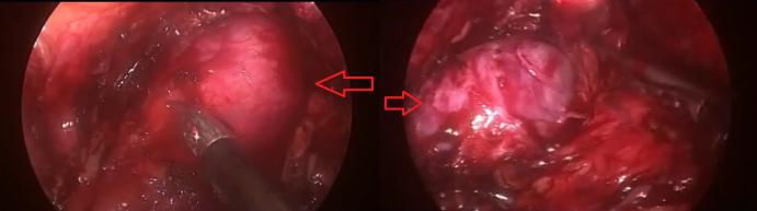 Figure 2: Anterior wall bulging in the bladder neck.