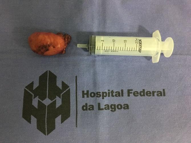 Figure 3: Bladder tumor seen by video laparoscopy.