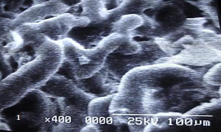 Figure 1: Short ramification of mature intermediate villi is observed with irregular microvilli.