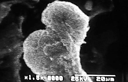 Figure 9: Section of mature villi is seen without uniform distribution of microvilli.