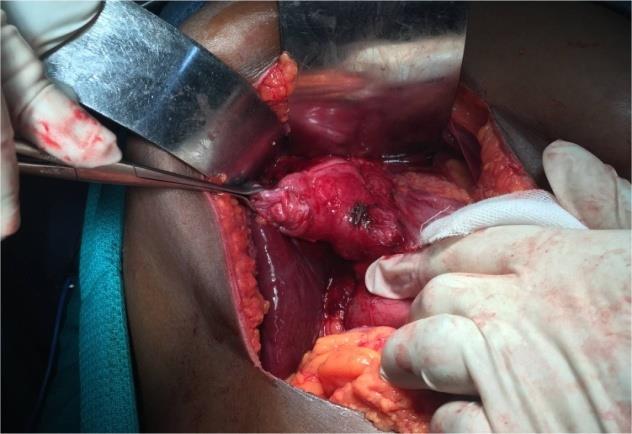 Figure 1: MRCP Showing Right Posterior Sectoral Duct Joining Cystic Duct (Type F Anomaly) With Mirizzi Syndrome Csendes Type 3.