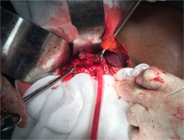 Figure 3: Common Bile Duct Stent Being Removed.