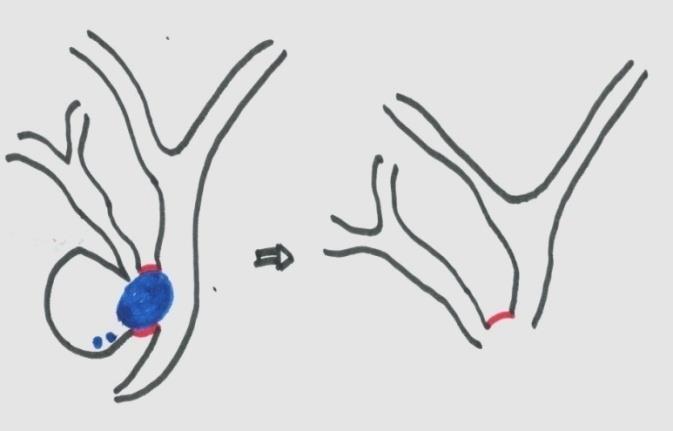 Figure 6: Simple pictorial representation of the Type F anomaly. Part of the cystic duct which is used as roof of hepaticojejunostomy is shown in red, stone – yellow.