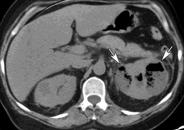 Figure 1: Emphysematous pyelonephritis of the left kidney.