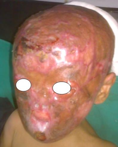 Figure 3: Postoperative picture with mouth opening of two fingers.