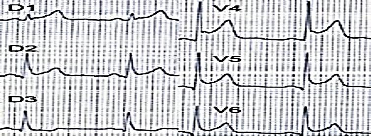 Figure 2: Classical Appearance ECG myocarditis, simulating a myocardial infarction. This myocarditis often results in an overall collapse of hypokinesia with ejection fraction (EF) on echocardiography, which was not the case for our patient: EF = 60%. Cardiac MRI (Figure 3), baseline examination confirmed the diagnosis of myocarditis by late contrast enhancement in intra myocardial or epicardial under which is a different specific element of ischemic pathology [7-9]. Transthoracic echocardiography objective often a global hyperkinesia with collapse of the ejection fraction, which in our case was without defects. This is cardiac MRI confirms the diagnosis by late contrast enhancement in intra myocardial or sub epicardial [7-9], observed in our patient. In our patient, the diagnosis was suspected in a moderate bradycardia to 50 per minute with premature ventricular contractions, and elevated cardiac enzymes at 50 times the normal rate (troponin Ic), confirmed by cardiac MRI taken late by the contrast subepicardial (Figure 3).