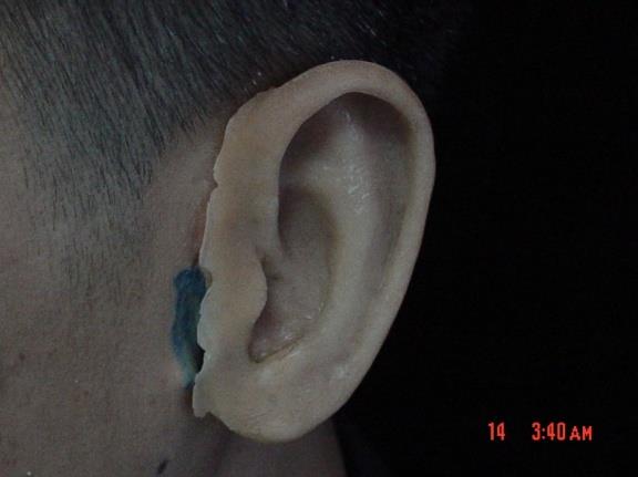 Figure 1: Previous patient’s auricular prosthesis.