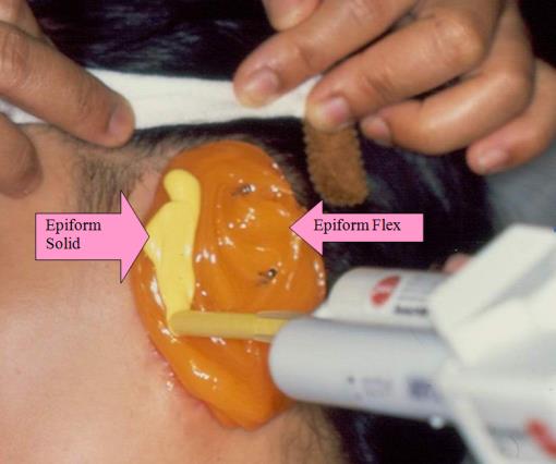 Figure 3: Taking impression with gelation polyvinylsiloxane; light body-Epiform Flex Dreve- Dentamid, Germany and heavy body- Epiform Solid (Dreve-Dentamid, Germany).