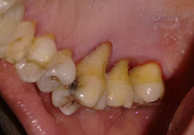 Figure 2: The patient was able to maintain adequate plaque control.