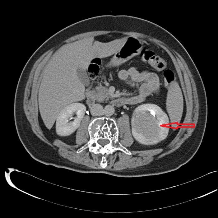 Figure 1: Lesion 52 mm in diameter which was observed to be slightly hyperdense from kidney parenchyma, contrast-enhancing in the arterial phase, and wash out in the late phase in the portal phase in unenhanced images.
