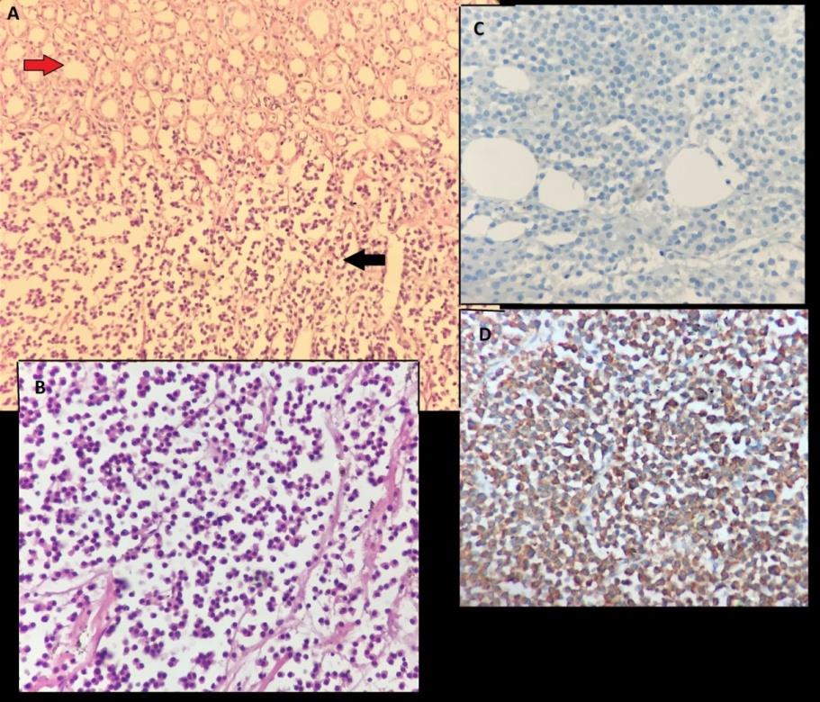 Figure 2: A) X100, H & E, atypical plasmocytic infiltration (red arrow) in kidney parenchyma (red arrow) B) X400, H & E, atypical plasmocytes C) X400, Lambda, Lambda negativity and D) X400, Kappa, kappa positivity.