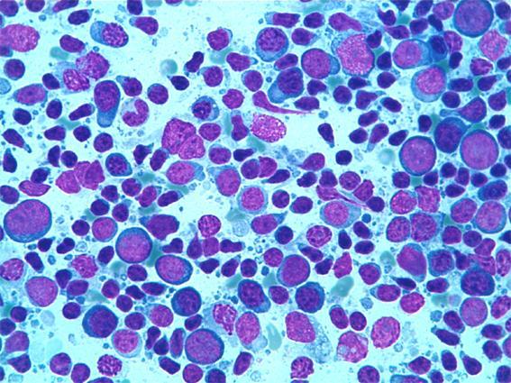 Figure 5: Follicular hyperplasia with numerous immunoblasts- aspiration cytology.