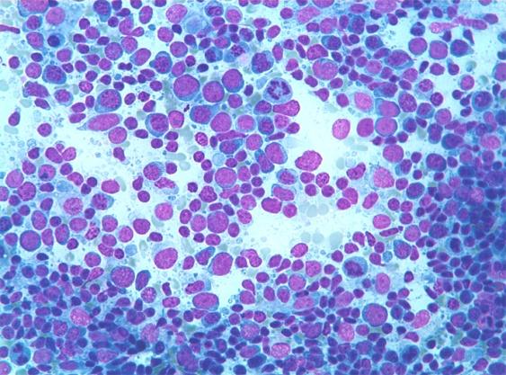 Figure 6: Mature lymphocytes with centroblasts- aspiration cytology.