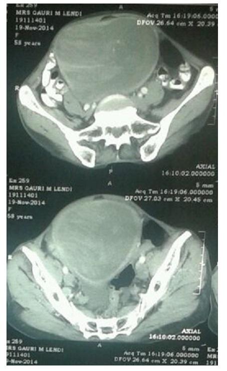Figure 1: Computed tomography scan view of tumour mass.