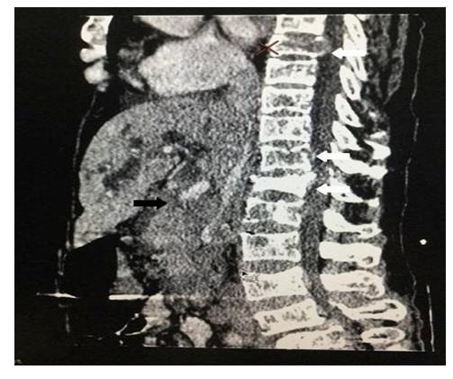 Figure 1: Sagittal section of contrast enhanced MDCT shows carcinoma gallbladder (black arrow) with mixed osteoblastic and lytic skeletal metastasis (white arrow).