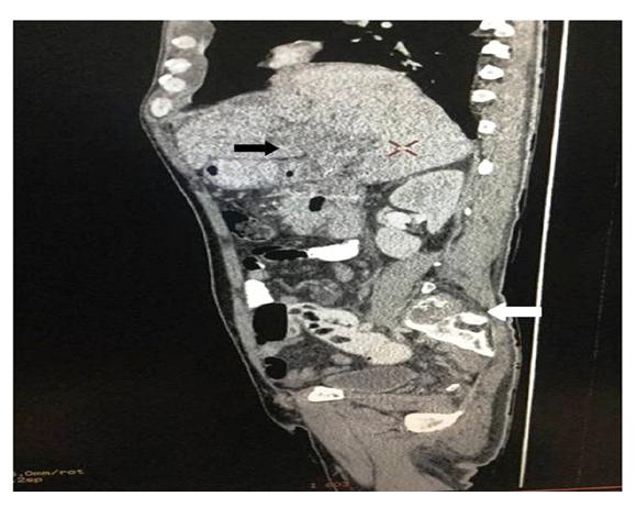 Figure 3: Sagittal section of contrast enhanced MDCT of a large mass replacing gallbladder fossa (black arrow) with sacral vertebral metastasis (white arrow).