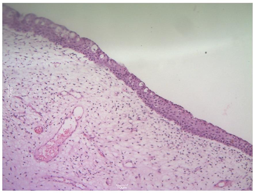 Figure 1: Mesenchymal tumour arranged in form of sheets of small tumor cells with dense cellularity around blood vessels. IHC (figure 2,3) showed Desmin positive which confirmed the diagnosis. Patient was followed up for one year, but there was no recurrence and she is doing fine.