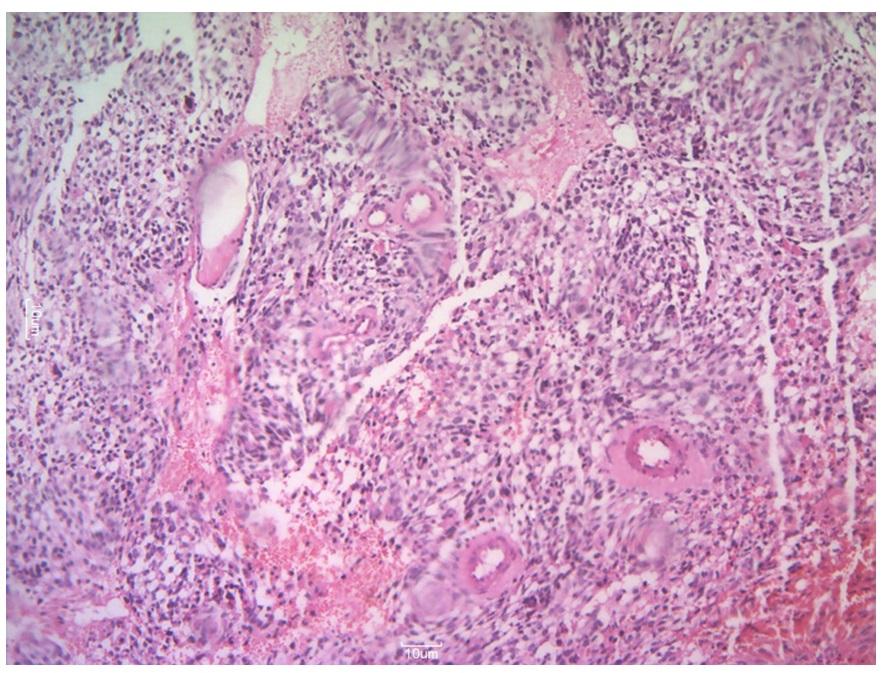Figure 2: Desmin positive which confirmed the diagnosis.