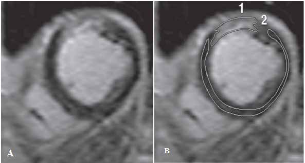 Figure 1: Example of an unrecognized myocardial infarction scar. (A) Delayed enhanced MRI in the short axis view showing delayed enhancement involving the subendocardial myocardium in the anterior wall of the left ventricle. (B) Signal intensity (SI) analysis of the myocardial scar. Two regions of interest (ROIs) were drawn to delineate the myocardial scar (ROI n.1) and the normal myocardium (ROI n.2). The scar has a total area of 1169.5 mm3 , corresponding to 4.38% of the total left ventricle mass, and has a SI ratio of 3.38.