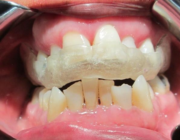 Figure 4: Intraoral photograph showing an acrylic splint.