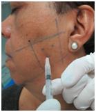 Figure 5: Electromyography of pie chart control where muscle activity is observed in the four quadrants after the infiltration of botulinum toxin.