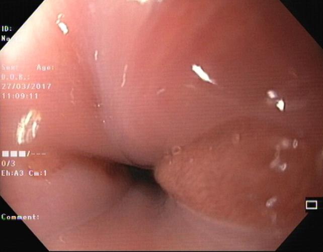 Figure 1: Heterotrophic gastric mucosal.