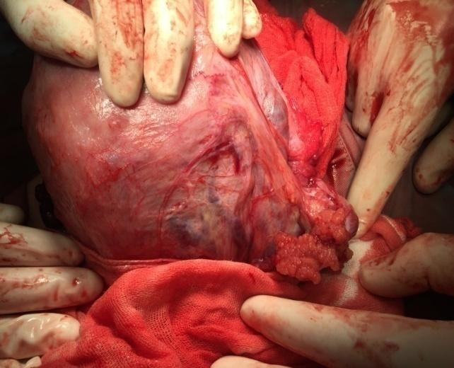 Figure 2: Right ovarian recurrent lesion during cesarean section.