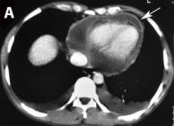 Figure 1: Computed tomography showing pericardial effusion with pericardium wall enhancement (arrow) and bilateral pleural effusion.